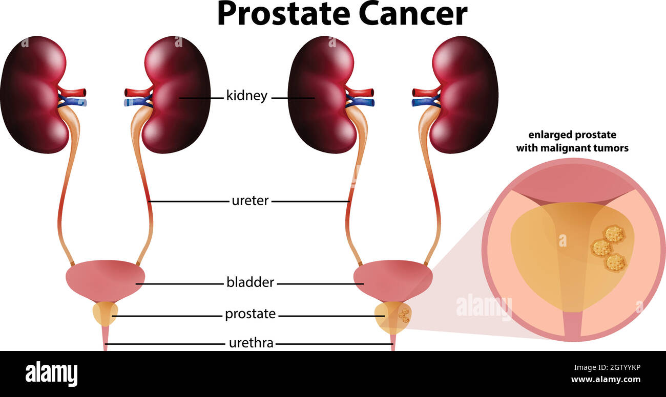 Cancro della prostata su sfondo bianco Illustrazione Vettoriale
