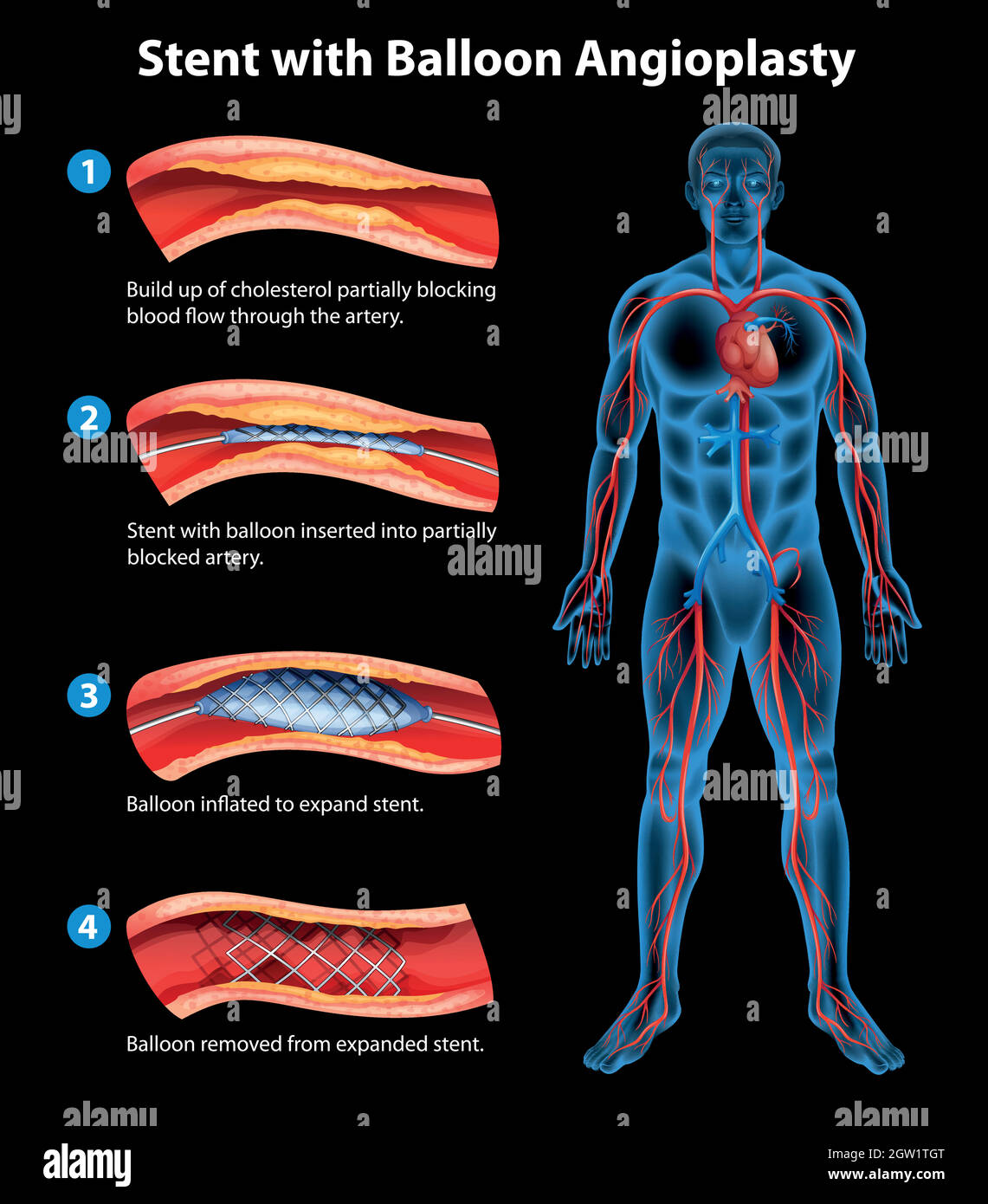 Procedura di angioplastica con stent Illustrazione Vettoriale