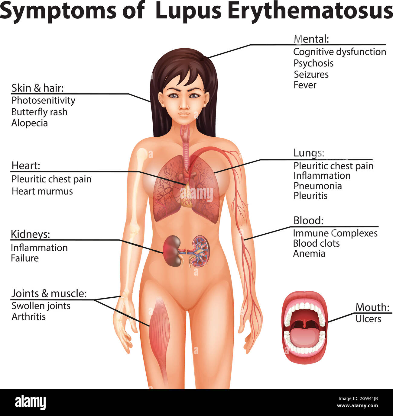 Anatomia umana sintomi di Lupus eritematoso Illustrazione Vettoriale