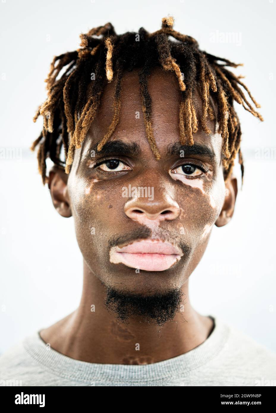 Giovane nero afroamericano con pelle vitiligina Foto Stock