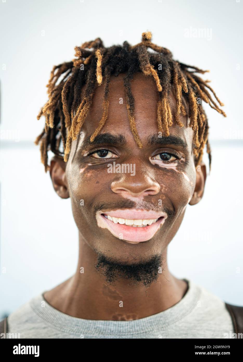 Giovane nero afroamericano con pelle vitiligina Foto Stock