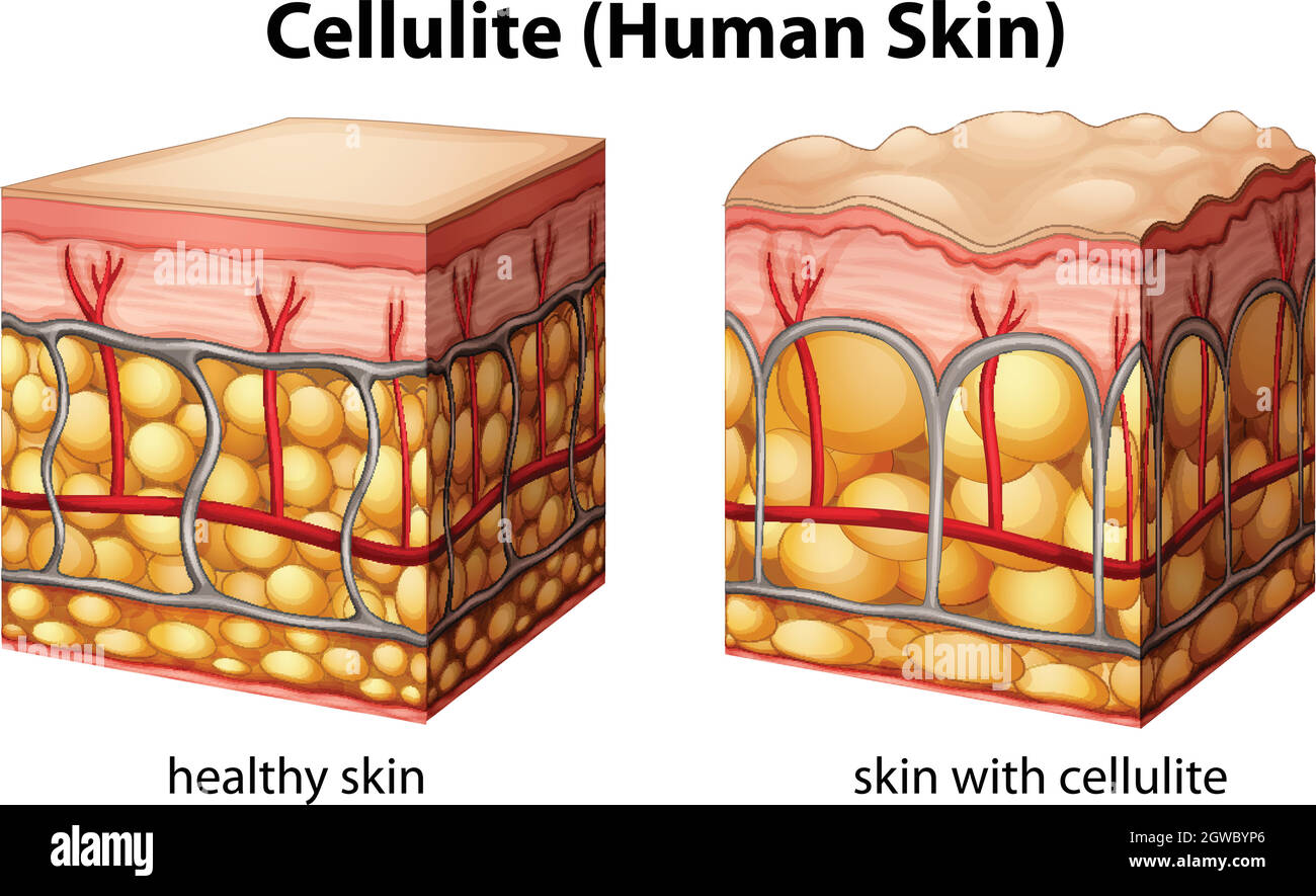 Cellulite Illustrazione Vettoriale