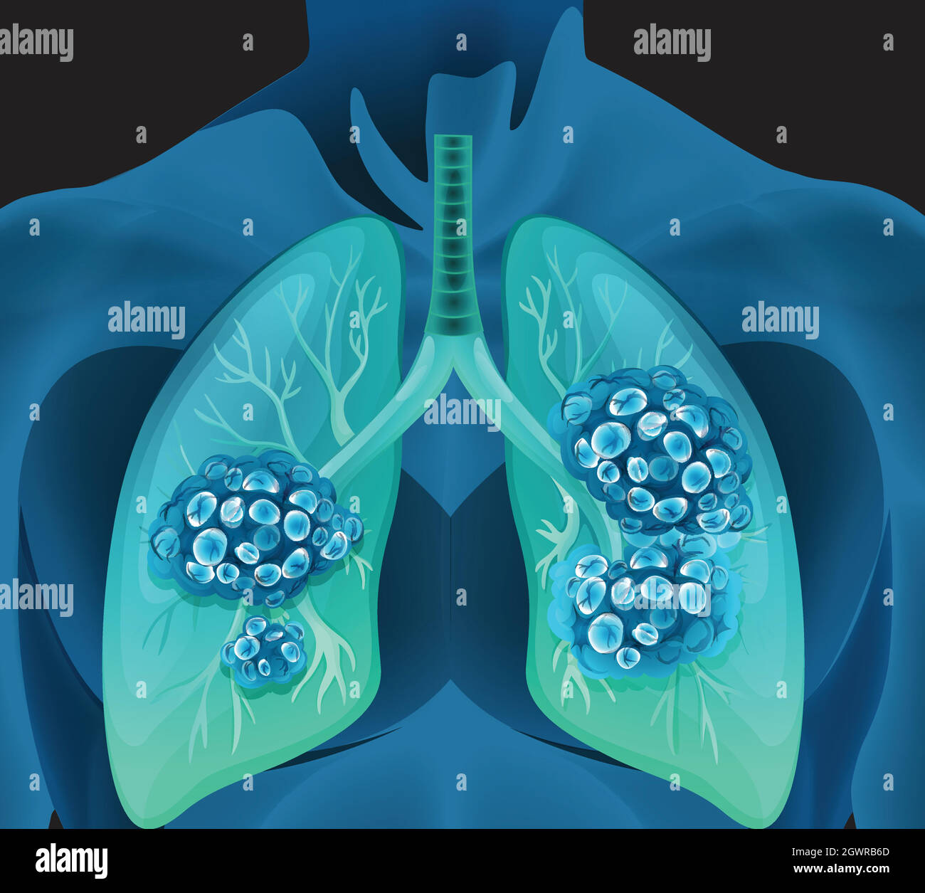 Cancro ai polmoni nel corpo umano Illustrazione Vettoriale
