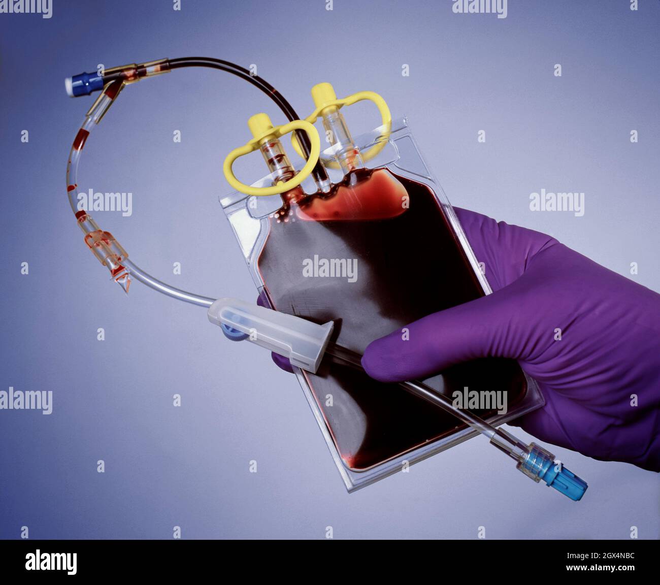 Sacchetto per il prelievo ematico del cordone ombelicale Foto Stock