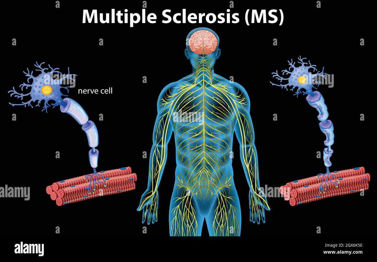 Anatomia umana della sclerosi multipla Illustrazione Vettoriale