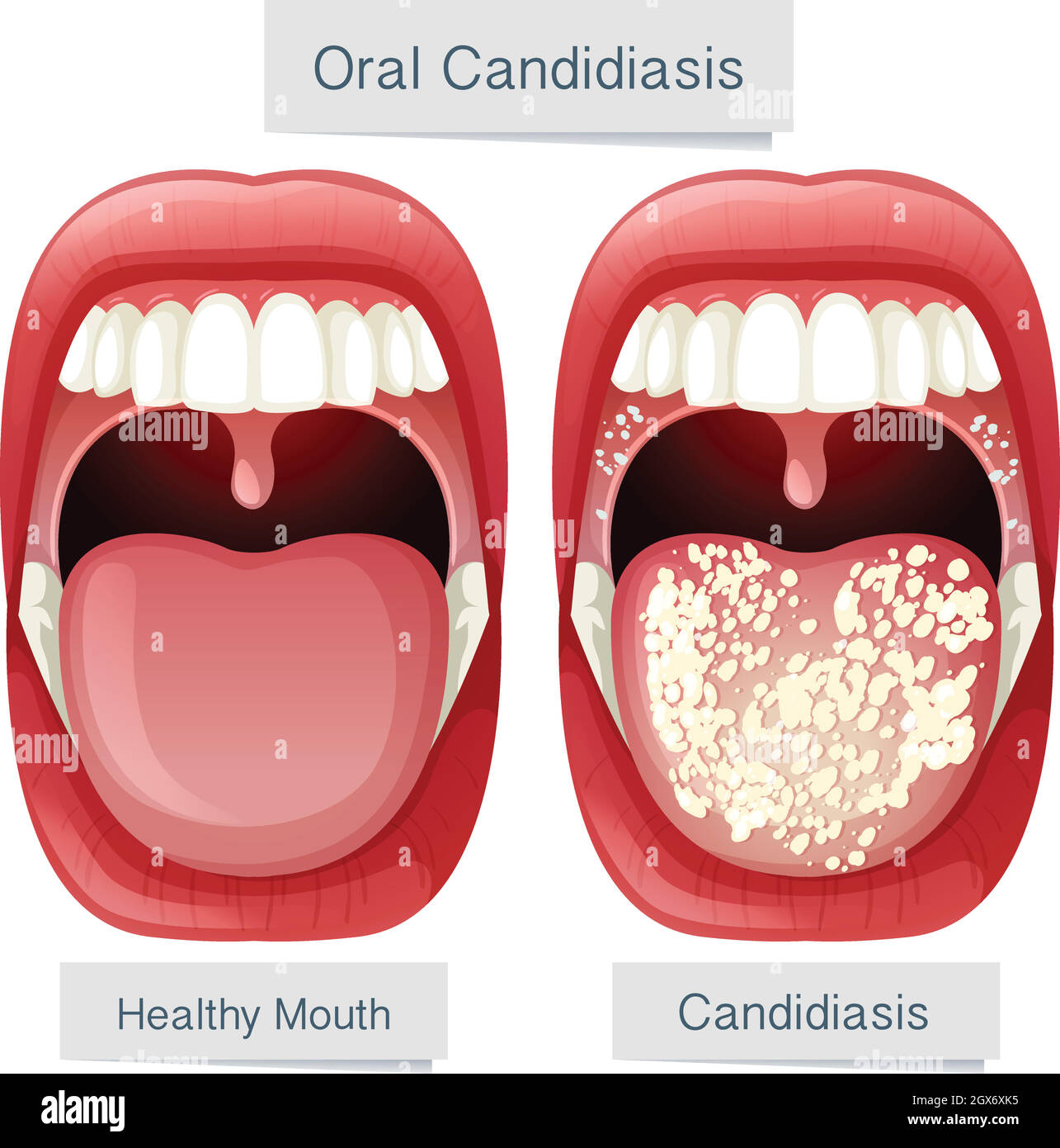 Anatomia della bocca umana Candidiasi orale Illustrazione Vettoriale