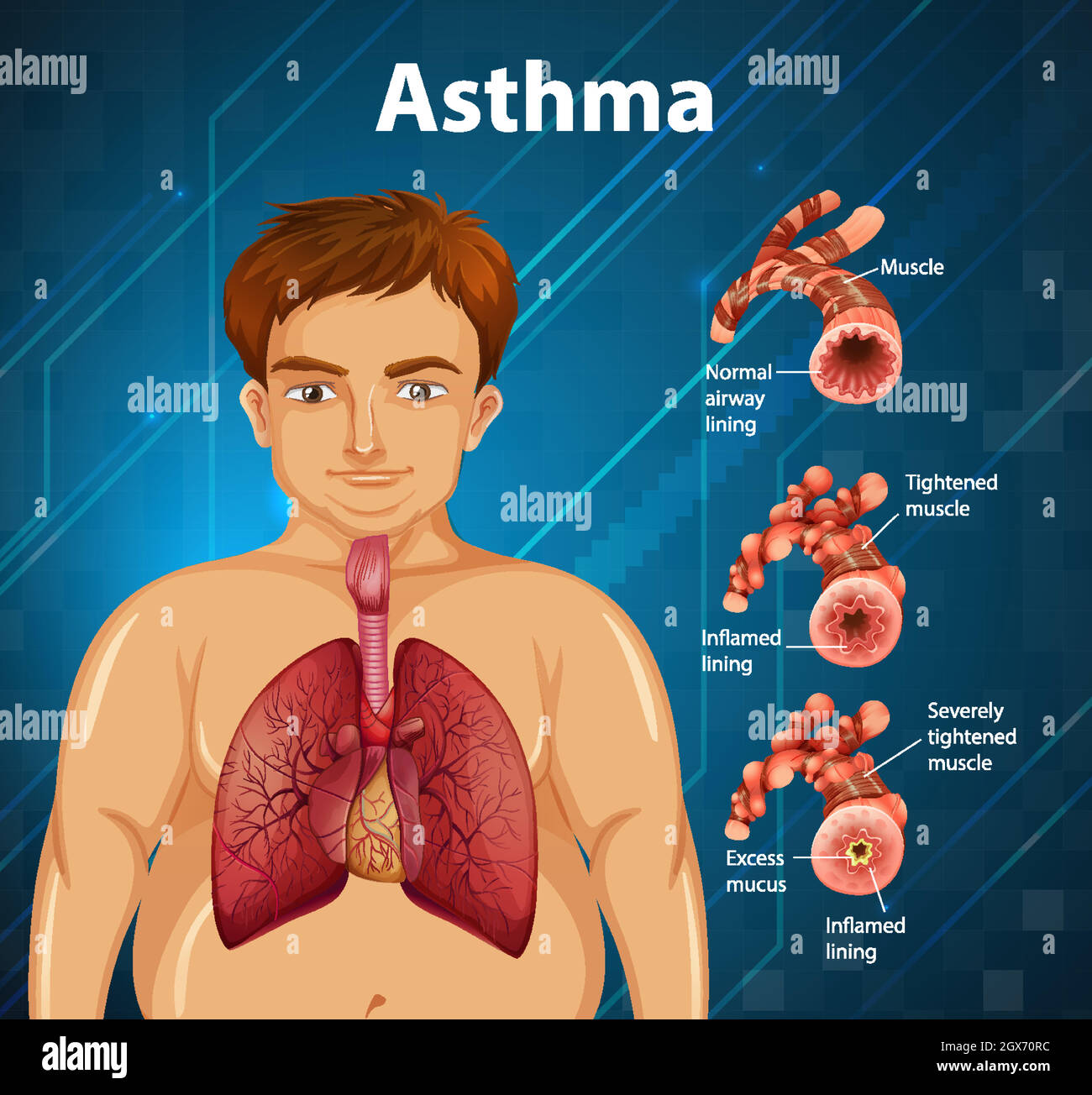 Diagramma dell'asma dell'anatomia umana Illustrazione Vettoriale