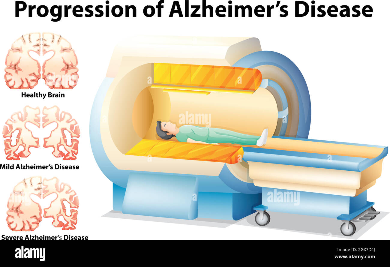 Progressione della malattia di Alzheimer Illustrazione Vettoriale
