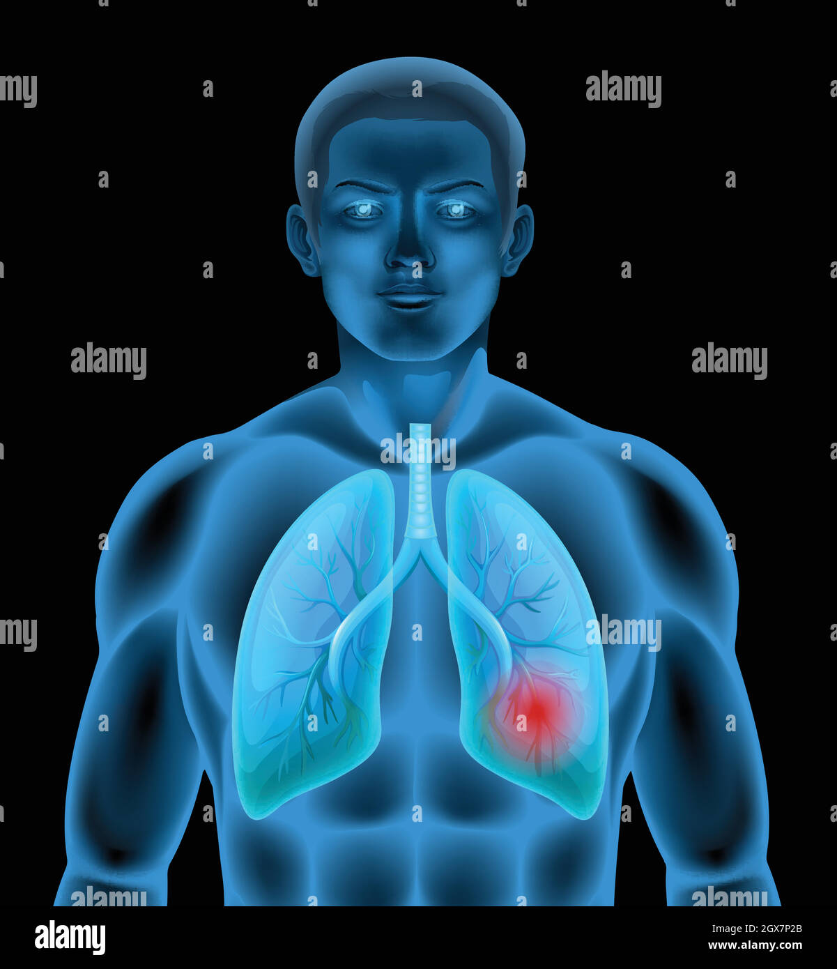 Un'anatomia umana della malattia polmonare Illustrazione Vettoriale