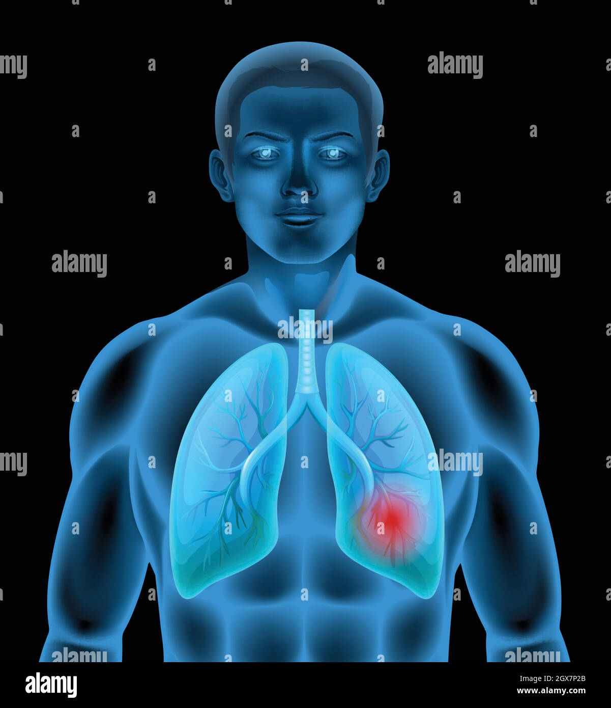 Un'anatomia umana della malattia polmonare Illustrazione Vettoriale Un'anatomia umana della malattia polmonare Illustrazione Vettoriale