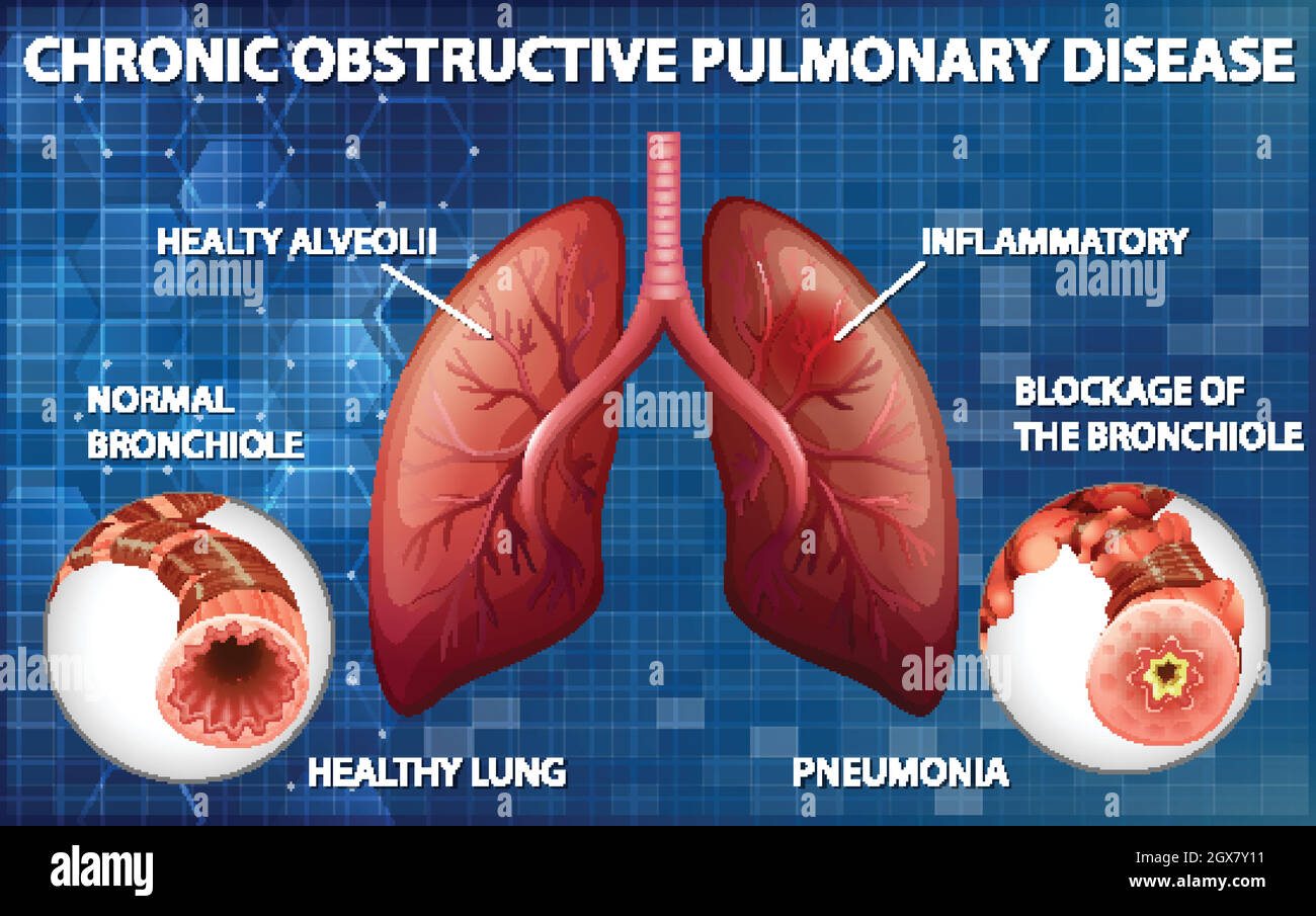 Polmone con malattia polmonare ostruttiva cronica Illustrazione Vettoriale