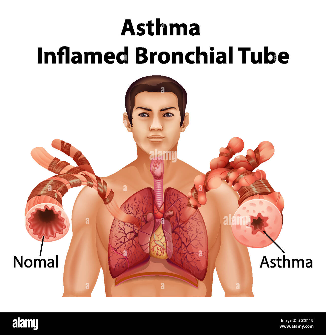 Anatomia umana Asma infiammazione del diagramma del tubo bronchiale Illustrazione Vettoriale