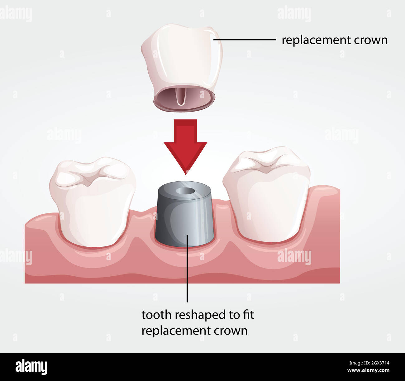 Procedura corona dentale Illustrazione Vettoriale