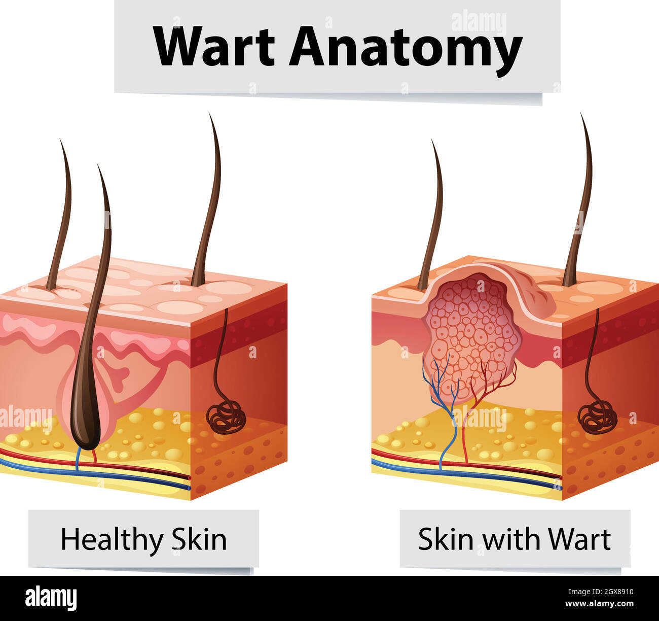 Illustrazione dell'anatomia della pelle umana di Wart Illustrazione Vettoriale