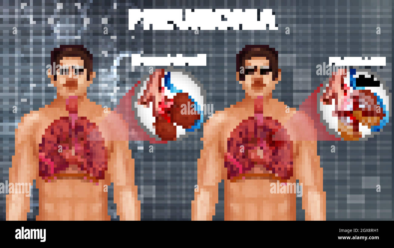 Anatomia umana che mostra polmonite Illustrazione Vettoriale