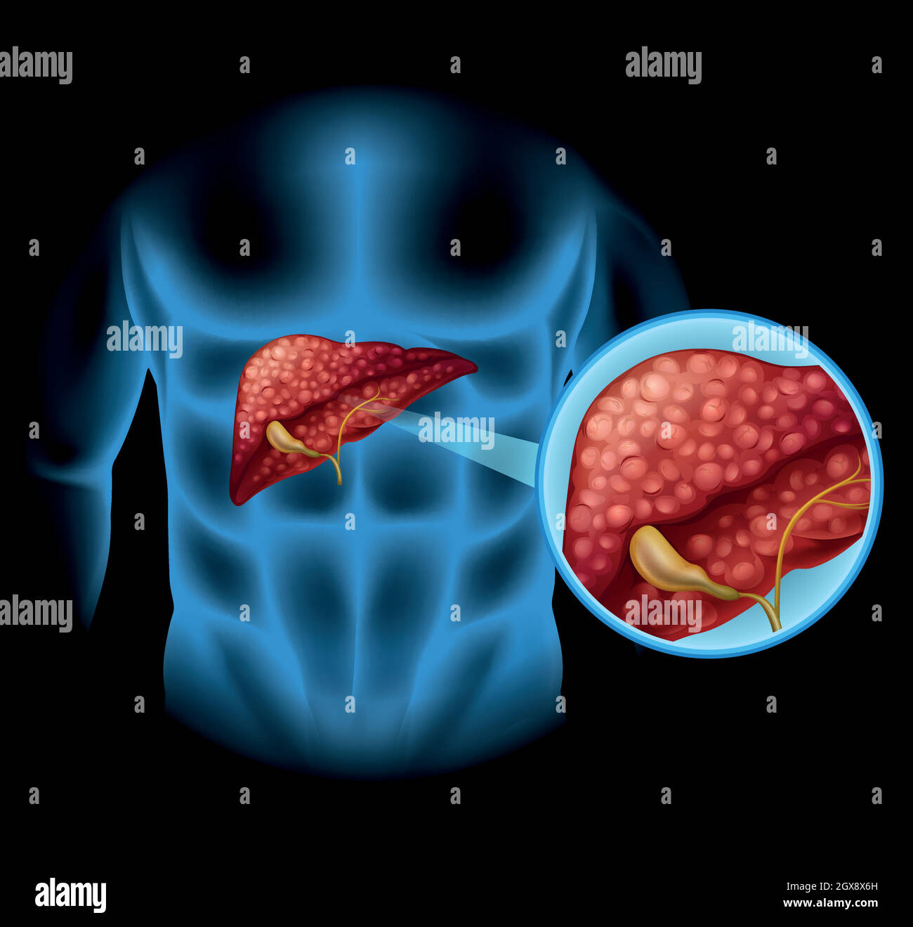 Diagramma della sclerosi nel corpo umano Illustrazione Vettoriale