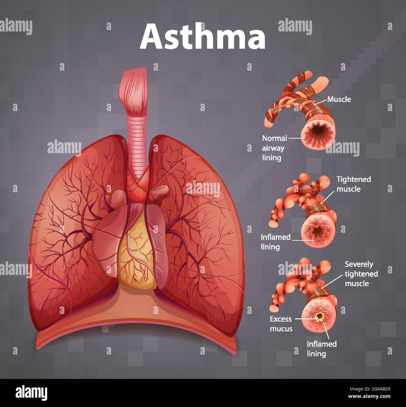 Diagramma dell'asma dell'anatomia umana Illustrazione Vettoriale