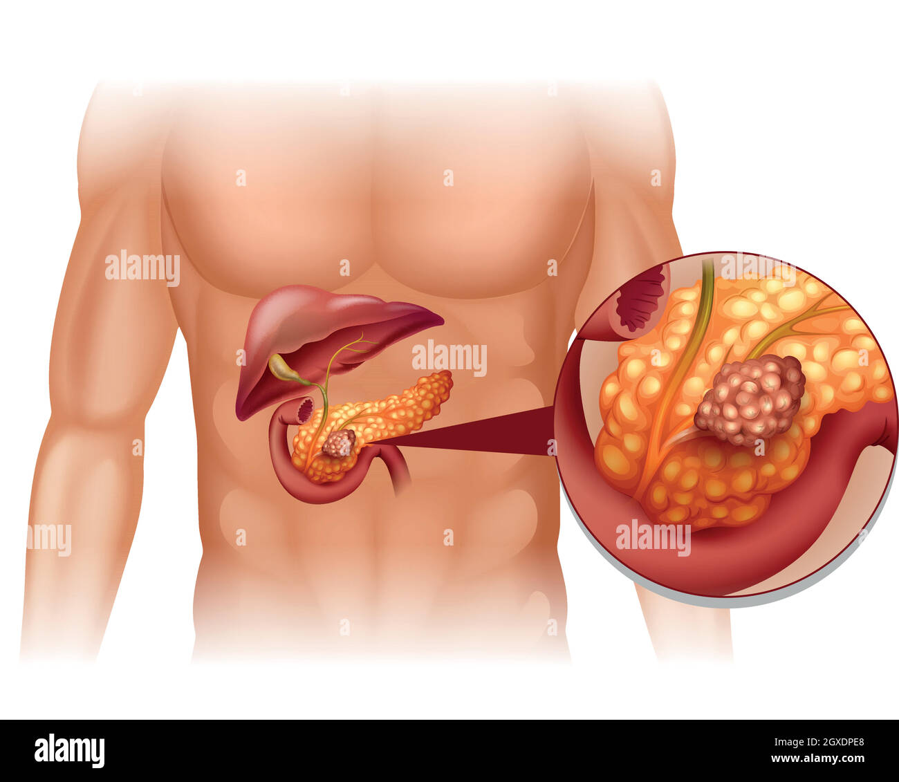 Cancro del pancreas nel corpo umano Illustrazione Vettoriale