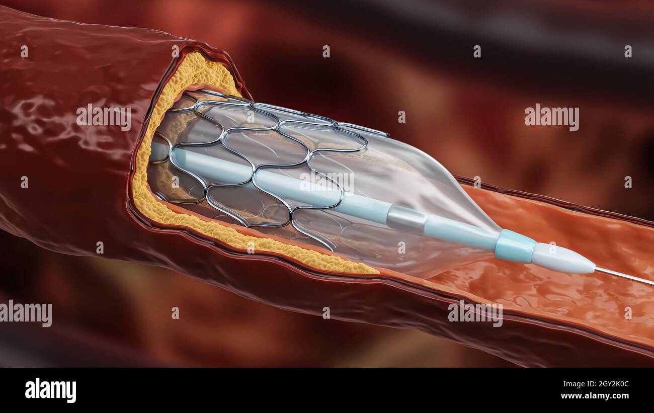 Illustrazione del rendering 3D dell'angioplastica. Rilascio di stent con palloncino dilatato all'interno di un'arteria malata o vaso sanguigno ostruito da colesterolo o ateroma Foto Stock