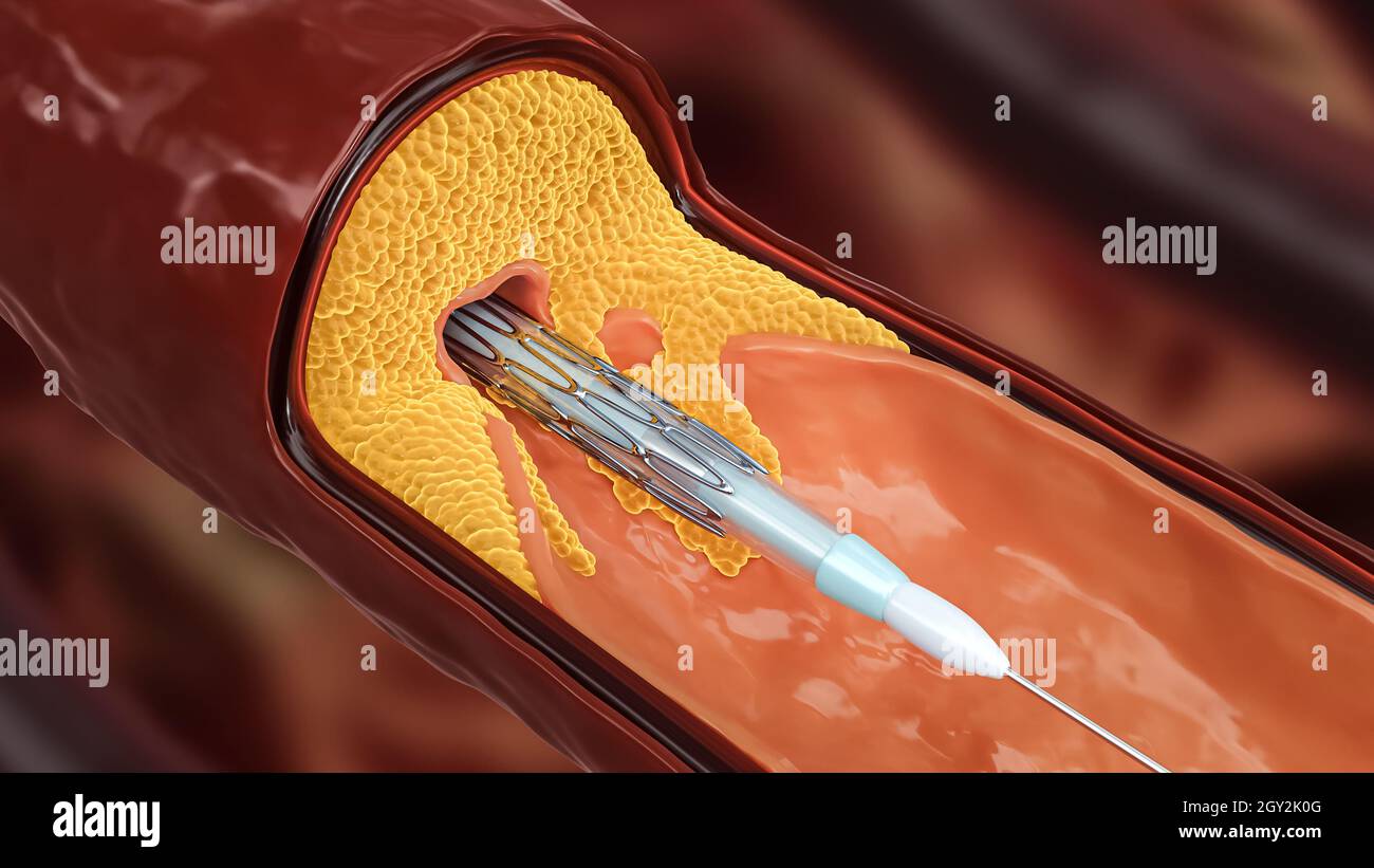 Illustrazione del rendering 3D dell'angioplastica. Rilascio di stent con palloncino collassato all'interno di un'arteria malata o vaso sanguigno ostruito da colesterolo o da un'athero Foto Stock