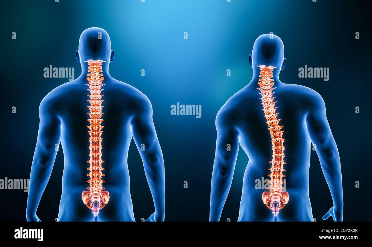 Confronto tra il backbone normale e la curvatura della scoliosi della colonna vertebrale con il modello maschio dall'illustrazione di rendering 3D della vista posteriore. Anatomia umana, spina Foto Stock