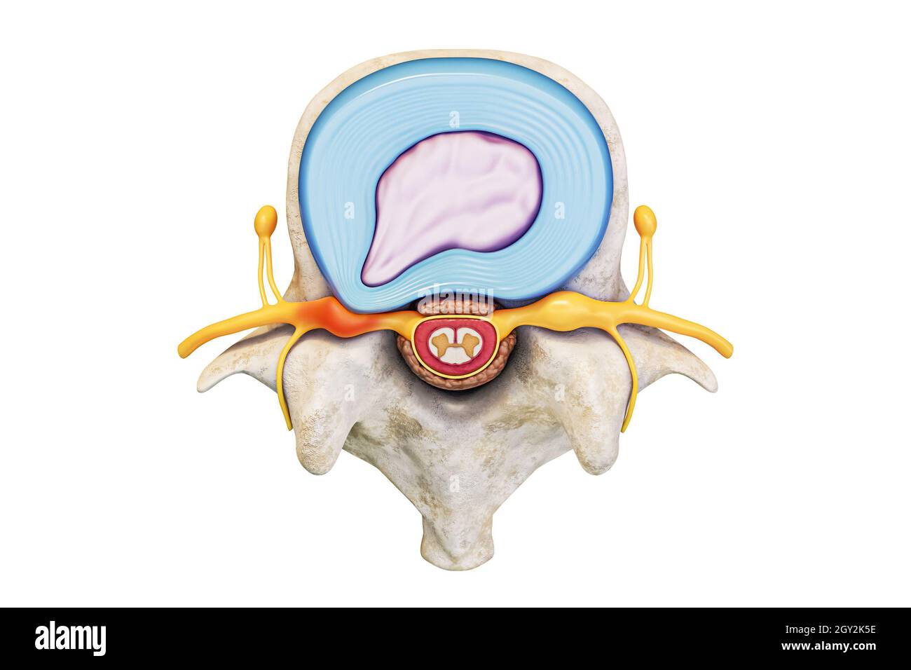 Vista superiore della vertebra lombare umana con disco erniato e midollo spinale isolato su sfondo bianco con rappresentazione 3D dello spazio di copia. Ana Foto Stock