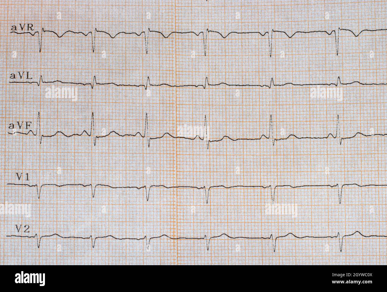 Foto ravvicinata di un elettrocardiogramma che mostra un aumento della frequenza cardiaca e delle aritmie cardiache. Elettrocardiogramma come diagnostica Foto Stock