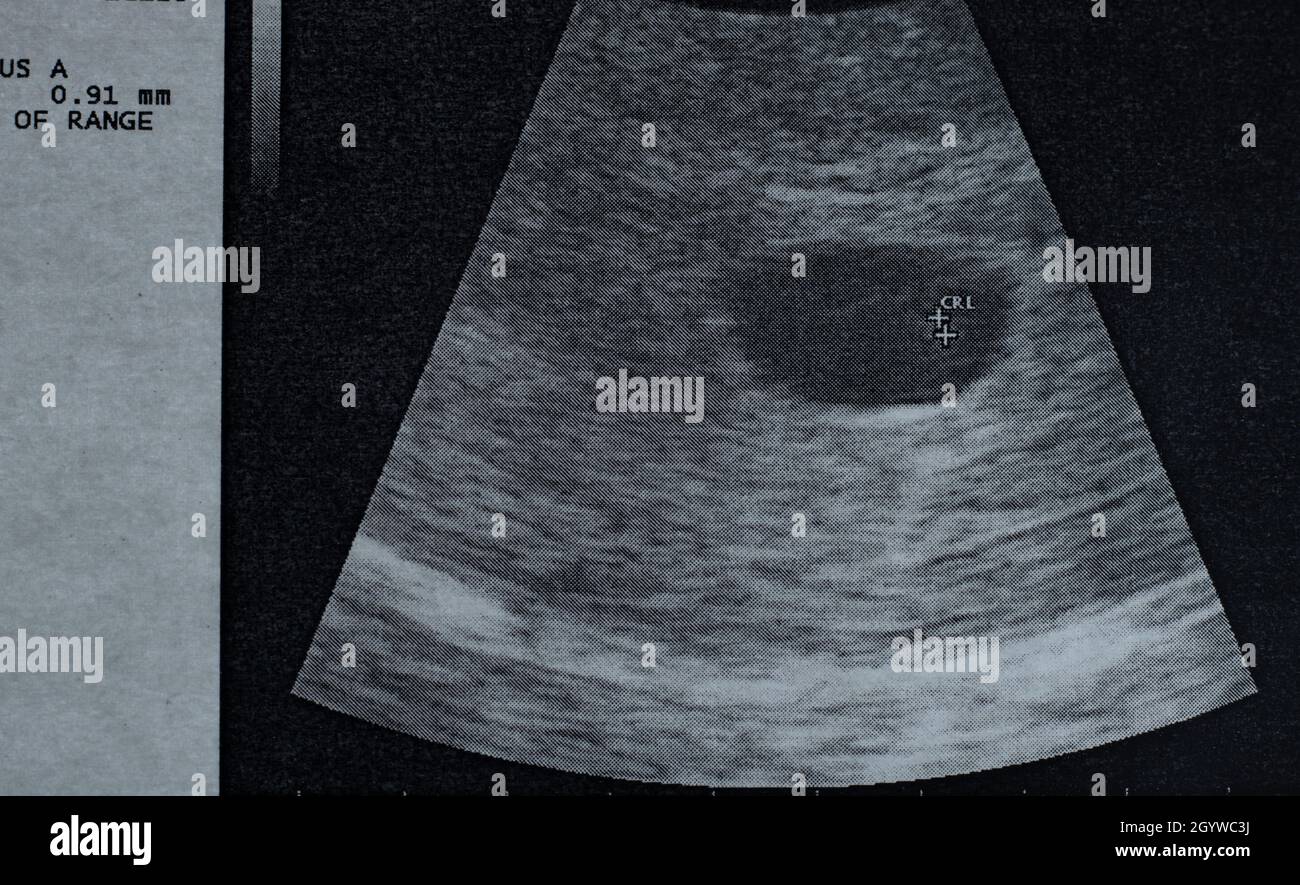 L'immagine ecografica dell'embrione senza battito cardiaco ha smesso di evolversi a 6 settimane Foto Stock