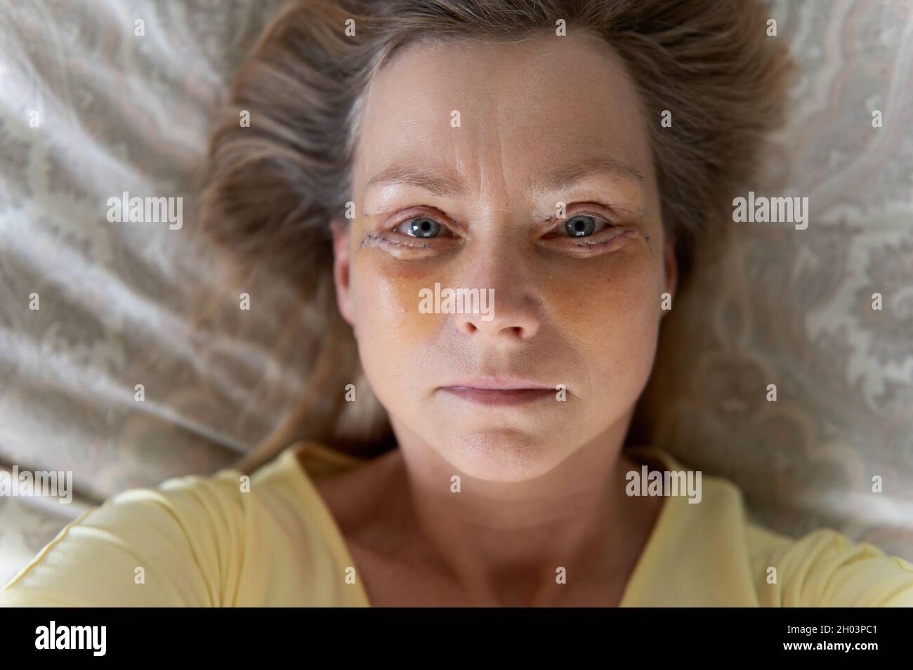 Selfie donna di mezza età sette giorni dopo l'intervento di blefaroplastica con doppia palpebra. Foto Stock
