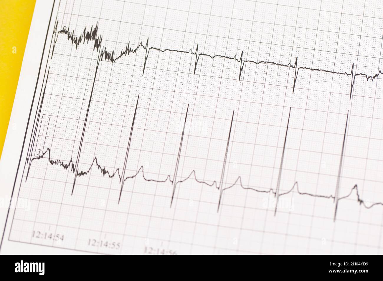Primo piano di ECG, elettrocardiogramma. Il lavoro di un cuore sano sulla carta. Foto Stock