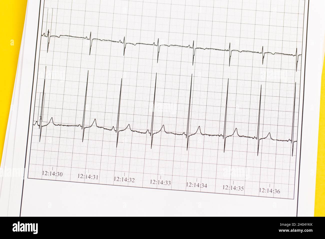 Primo piano di ECG, elettrocardiogramma. Il lavoro di un cuore sano sulla carta. Foto Stock
