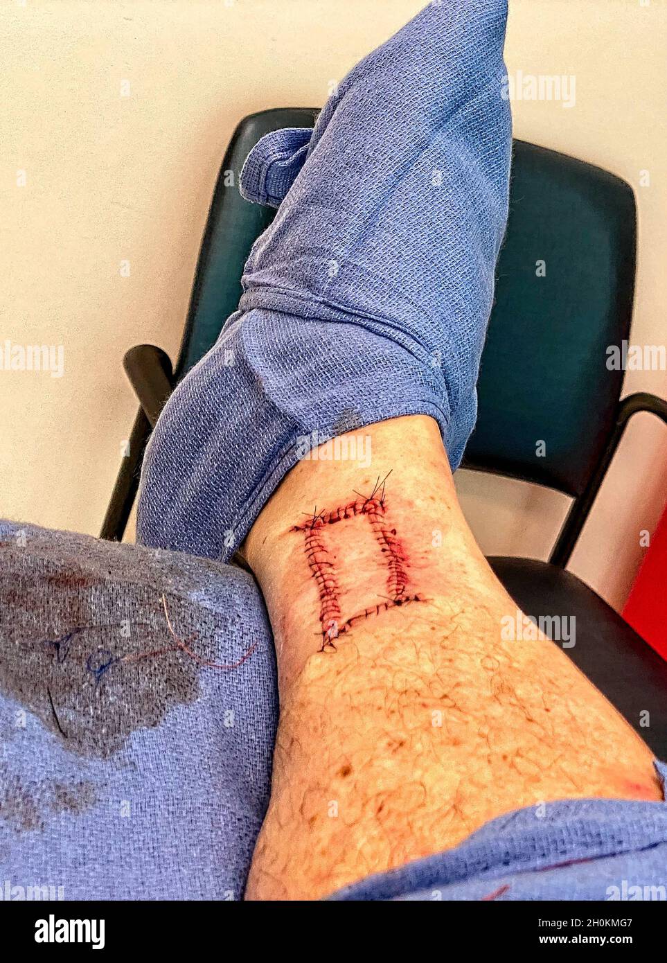 Mohs chirurgia sulla gamba destra mostrando punti prima del rilascio per consentire la guarigione a casa Foto Stock