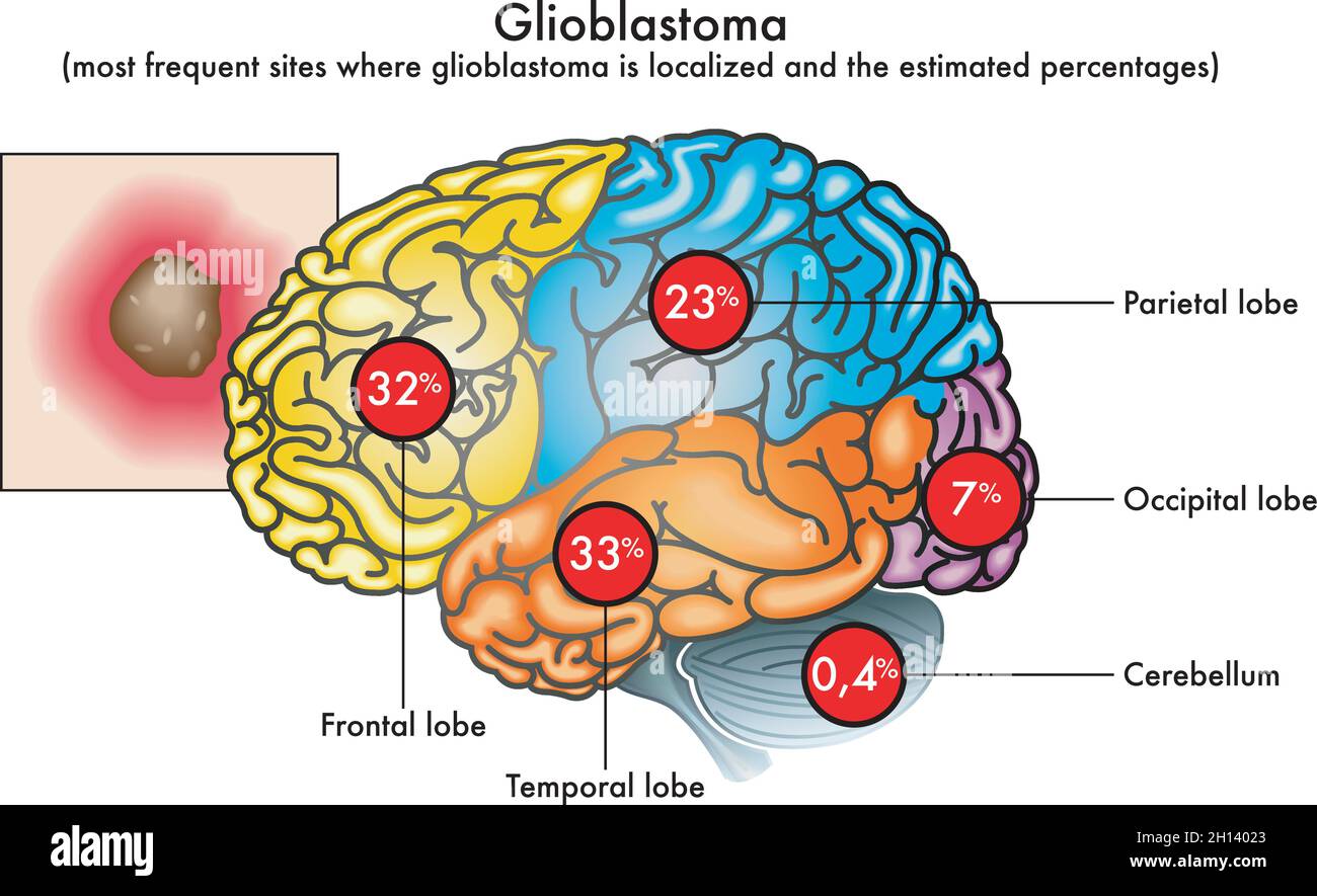 Illustrazione medica dei siti più frequenti in cui il glioblastoma è localizzato nel cervello e le percentuali stimate. Illustrazione Vettoriale