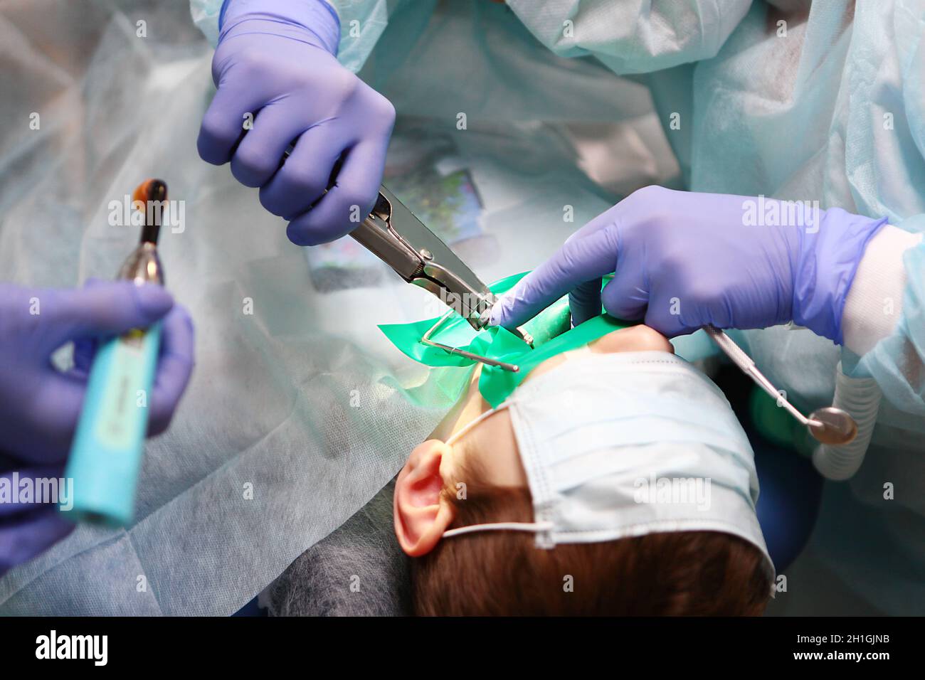 Chirurgia dentale. Un chirurgo dentale pediatrico esegue un'operazione per trattare le carie profonde in un bambino.concetto di salute e prevenzione.Copia spazio. Foto Stock