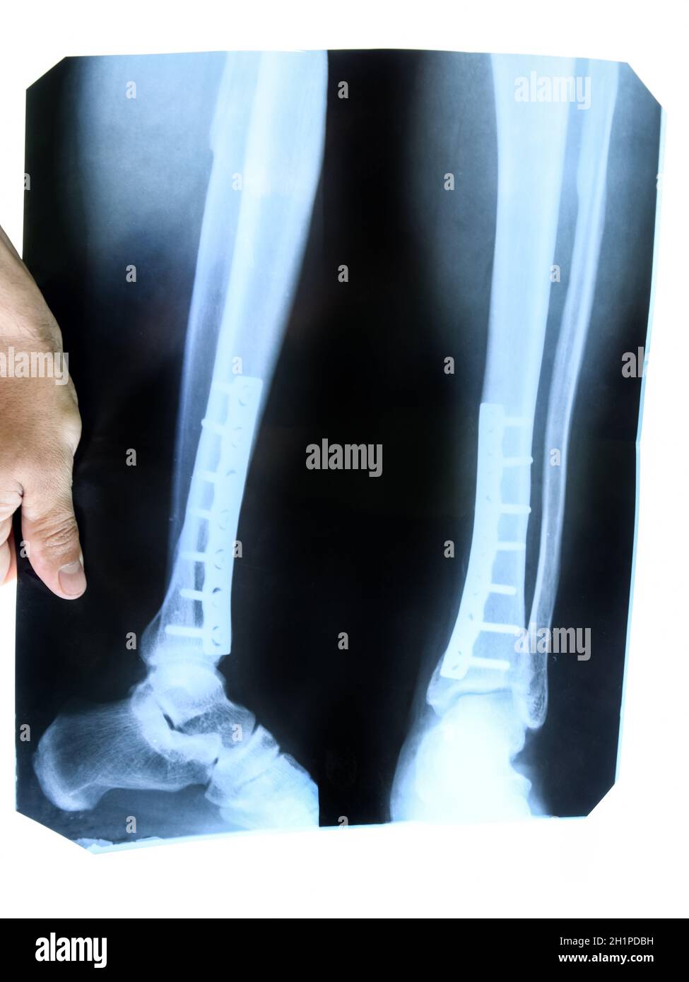 Raggi X della gamba. Una piastra di acciaio che tiene insieme la tibia della gamba. Foto Stock