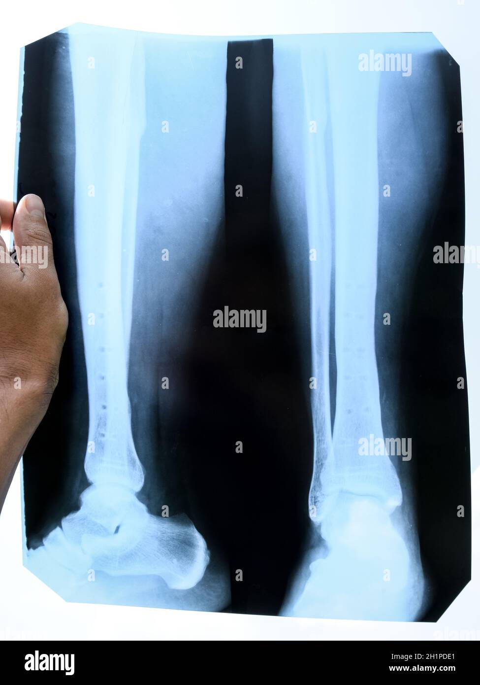 Fuse le ossa della parte inferiore della gamba dopo la rimozione del legante di acciaio piatto, raggi x della gamba Foto Stock
