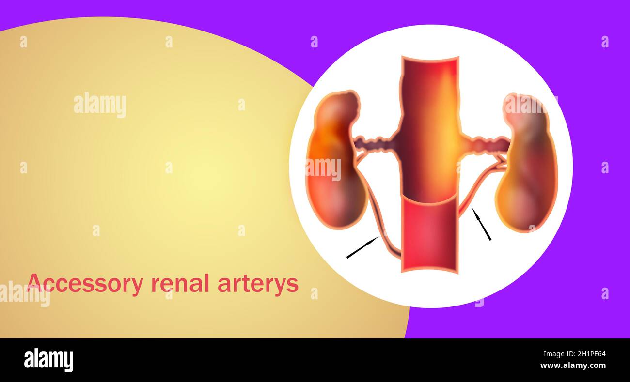 Le arterie renali accessorie o Aras sono resti embrionali che si trovano in più di un terzo dei pazienti e che si verificano bilateralmente nel 10% del papul Foto Stock