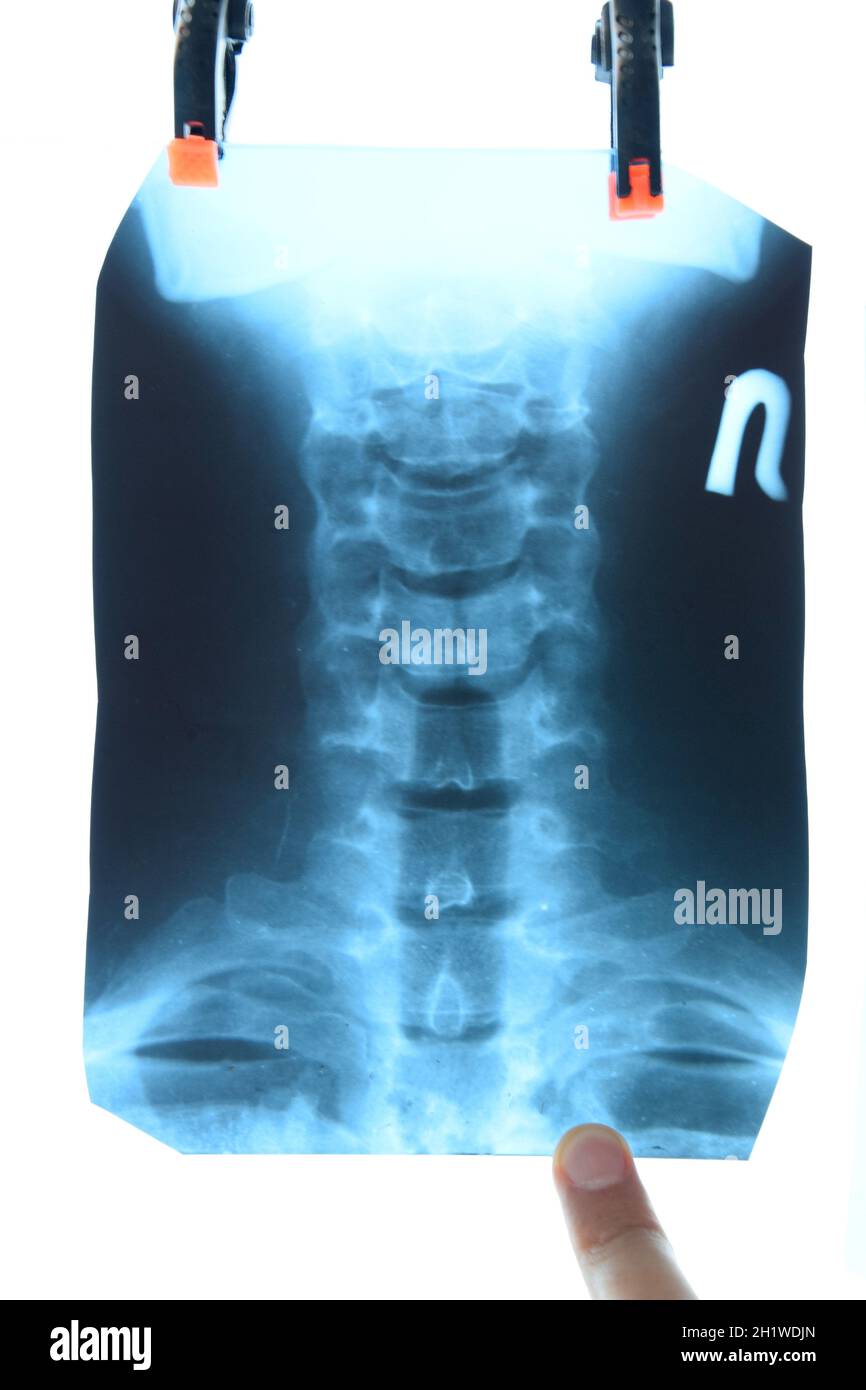 X-ray delle vertebre cervicali. Immagine a raggi X della colonna vertebrale cervicale. Foto Stock X-ray delle vertebre cervicali. Immagine a raggi X della colonna vertebrale cervicale. Foto Stock