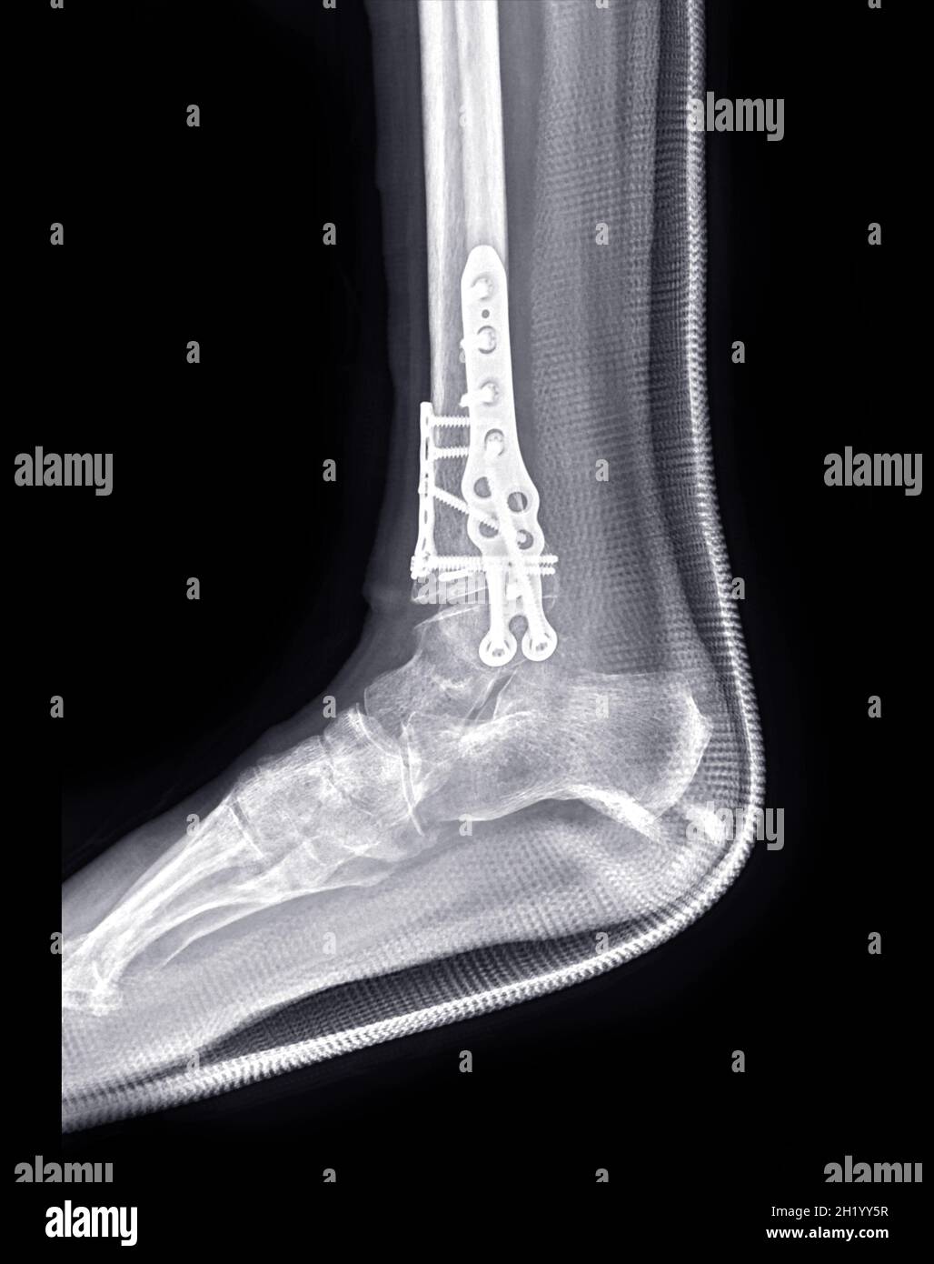 Immagine radiologica dell'articolazione della caviglia che mostra il trattamento chirurgico mediante fissaggio interno con piastra e vite. Foto Stock