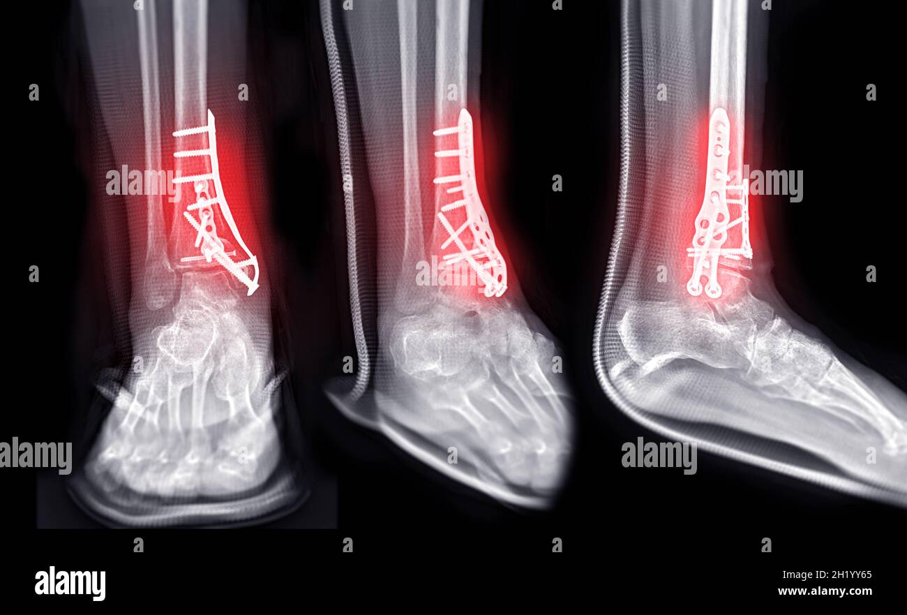 Immagine radiologica dell'articolazione della caviglia che mostra il trattamento chirurgico mediante fissaggio interno con piastra e vite. Foto Stock