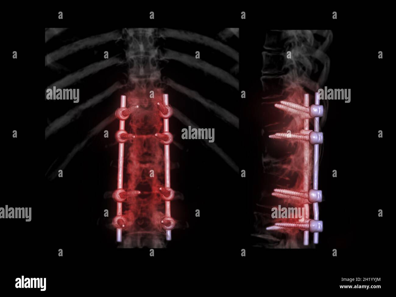 Colonna lombare AP e vista laterale per diagnosi stenosi del canale spinale e malattia degenerativa del disco che mostra l'impianto a vite pediculosa dopo la depom chirurgica Foto Stock