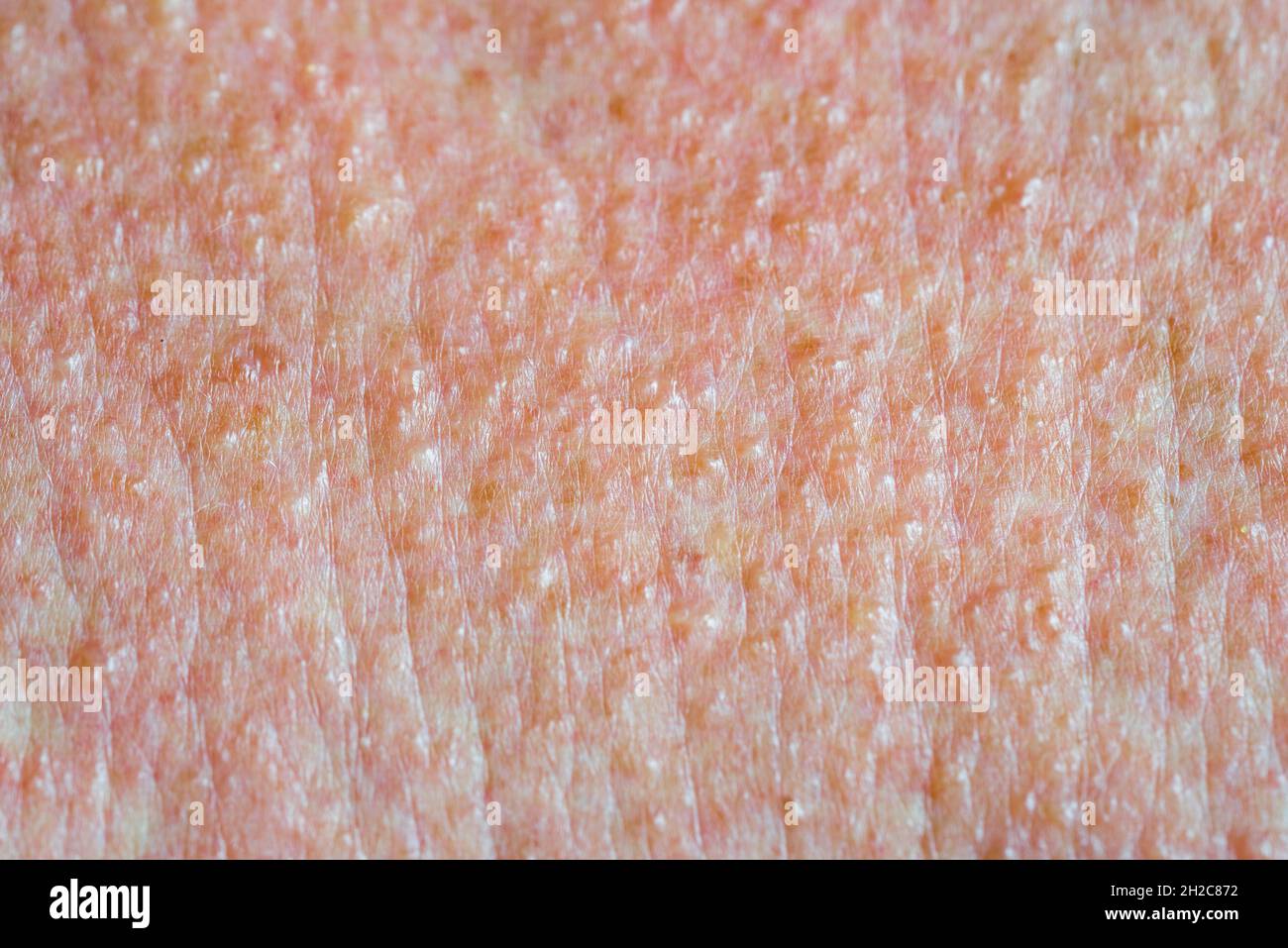 Tessuto cutaneo doloroso in vesciche rosse rash cutanei dopo ustione chimica Foto Stock