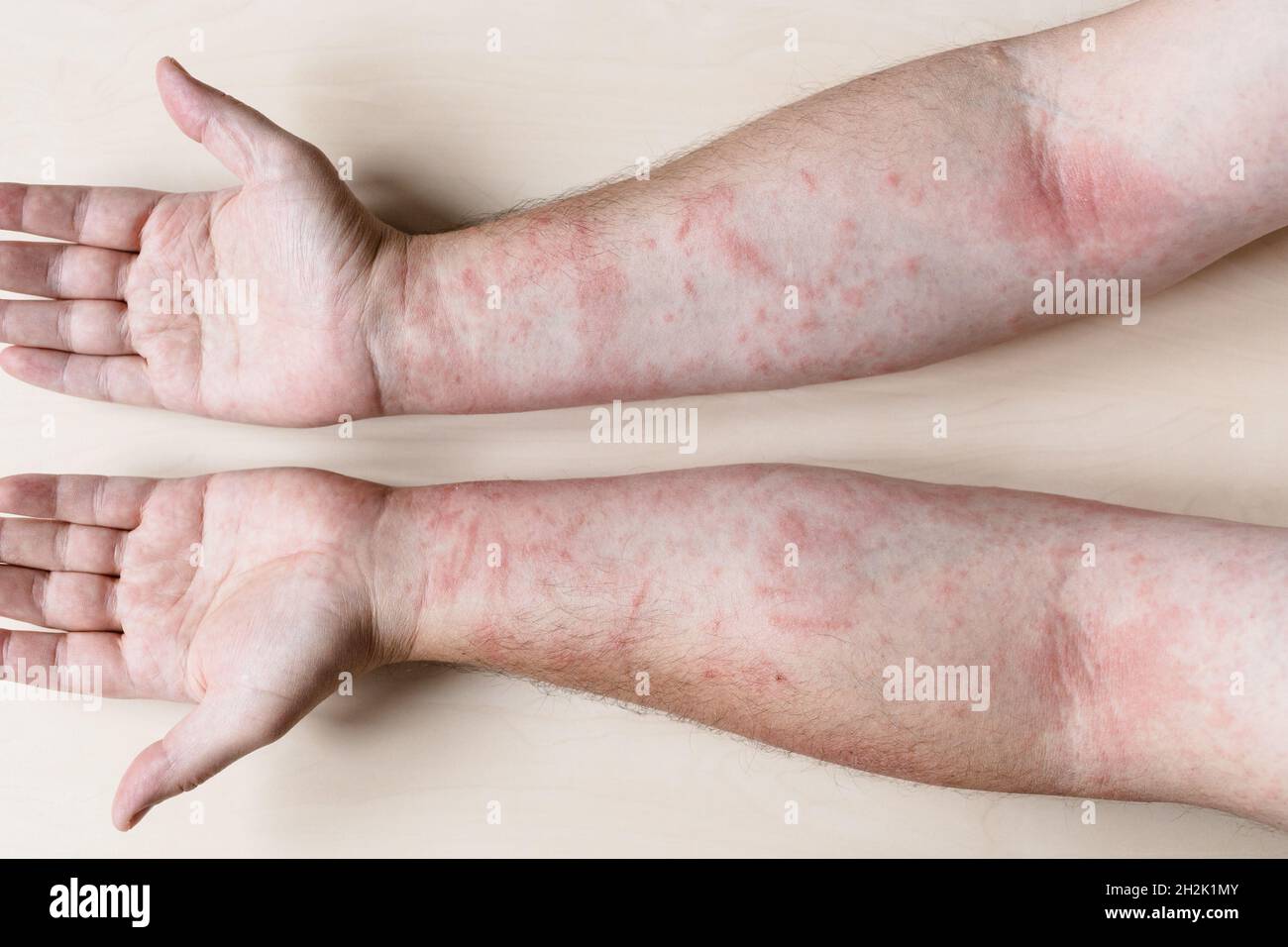 Dermatite allergica da contatto immagini e fotografie stock ad alta  risoluzione - Alamy