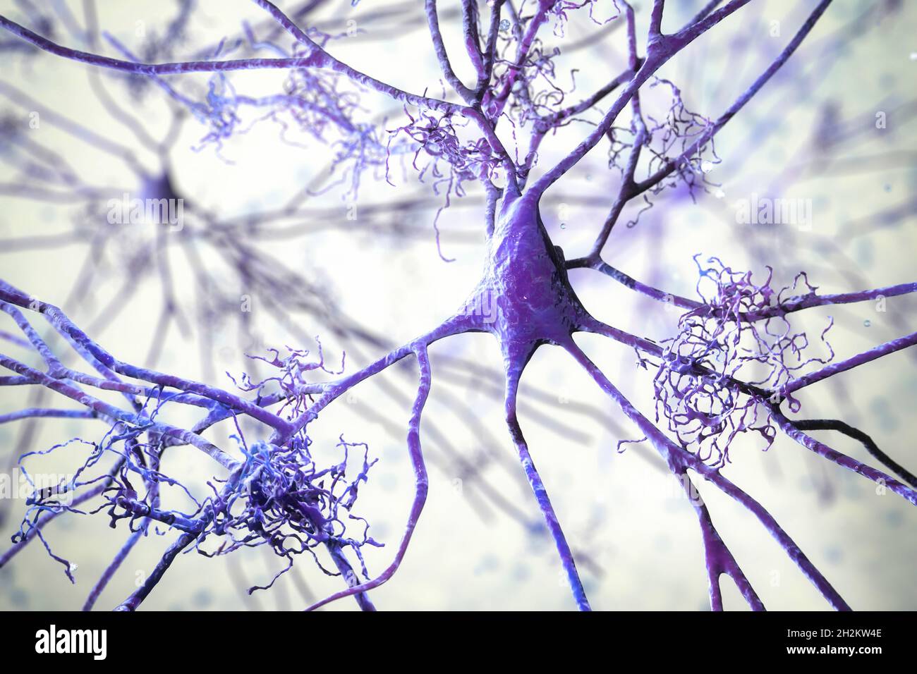Cellule nervose colpite dal morbo di Alzheimer, illustrazione Foto Stock