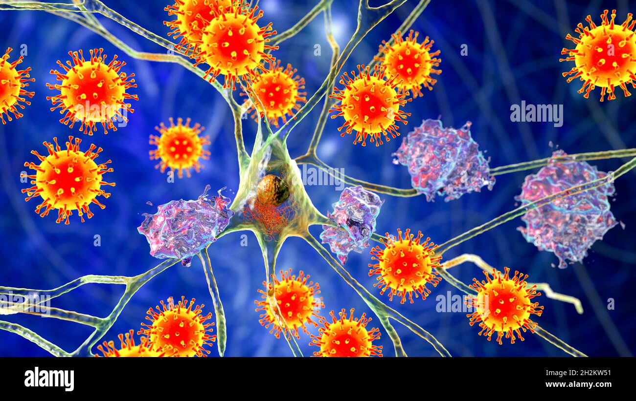 Eziologia infettiva della demenza, illustrazione concettuale Foto Stock