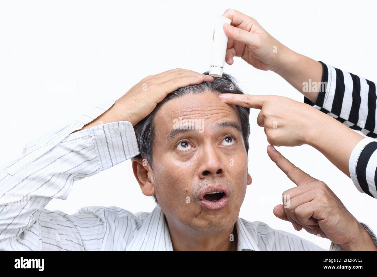 Calvizie (perdita di capelli) ha portato alla crisi di metà vita Foto Stock