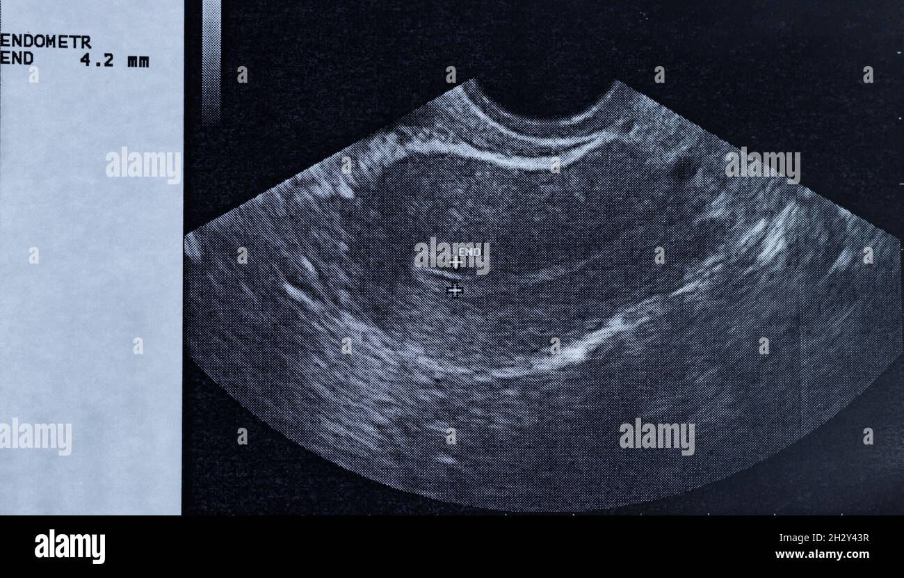 Ecografia dell'utero di una donna che mostra le dimensioni dell'endometrio Foto Stock
