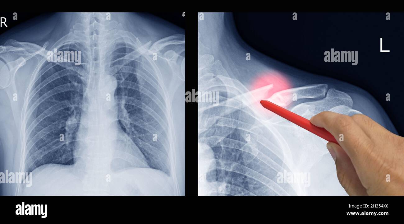 Primo piano X-ray spalla e clavicola frattura dolore in un uomo, medico tenendo un punto penna rosso, sintomi medico concetto di assistenza sanitaria. Foto Stock