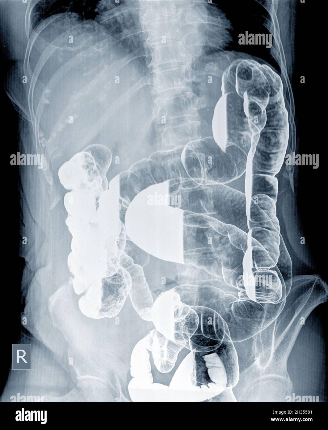 Esame radiologico per cercare le anomalie del colon da enema la polvere di bario e l'aria nell'ano. Quindi è stata eseguita la radiografia. Concetto di immagine medica. Foto Stock