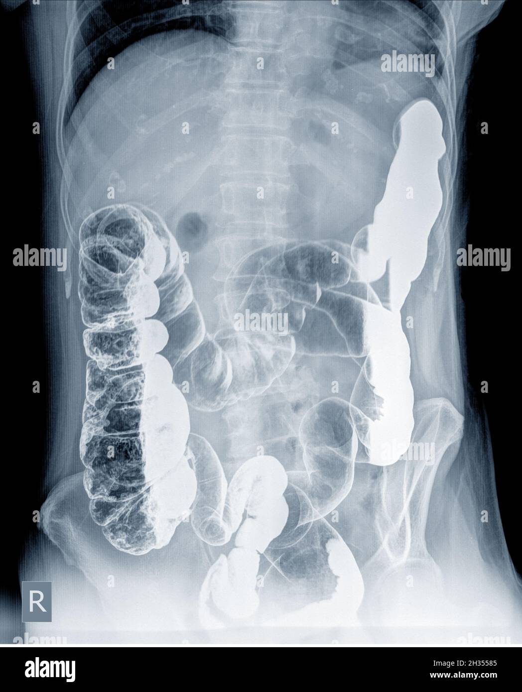 Esame radiologico per cercare le anomalie del colon da enema la polvere di bario e l'aria nell'ano. Quindi è stata eseguita la radiografia. Concetto di immagine medica. Foto Stock